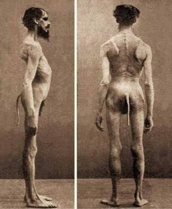 8. Человек, родившийся с хвостом.😐