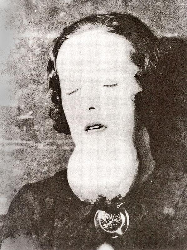 19. Radyum zehirlenmesi kaynaklı çenesinde tümör oluşmuş, Radyum Kızları diye tabir edilen kadınlardan sadece biri, 1920'ler.