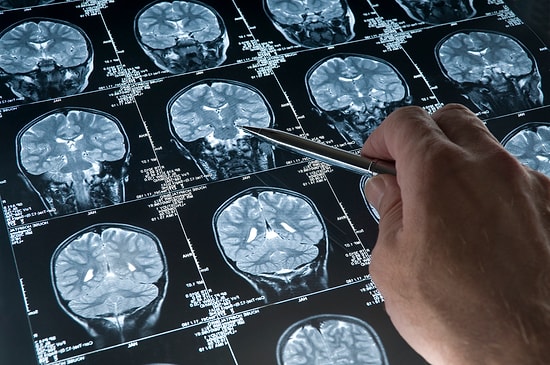 Ailesinde veya Yakın Çevresinde Alzheimer Hastası Olanların Çok İyi Bildiği 15 Şey