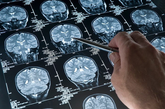 Ailesinde veya Yakın Çevresinde Alzheimer Hastası Olanların Çok İyi Bildiği 15 Şey