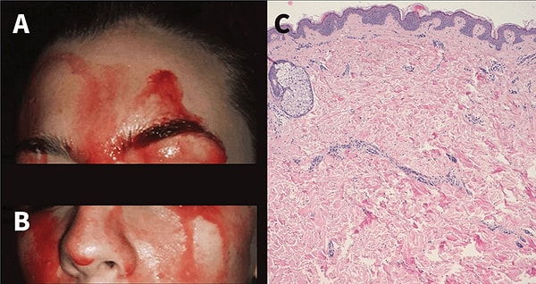 3. После того, как женщину обследовали врачи, выяснилось, что пациентка страдает гематидрозом — патологическим состоянием, при котором пот смешивается с кровью.