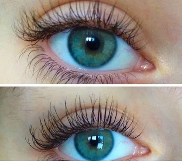 17. Так выглядит дистихиаз — заболевание, когда ресницы растут в 2 ряда. Пожалуй, лучшее заболевание, которое только может быть!