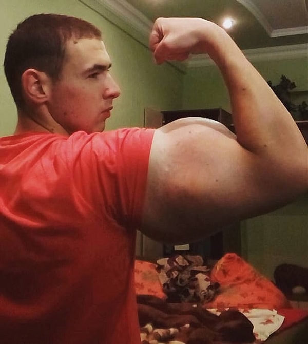 4. Доктора предупреждают, что синтол может вызвать тромб артерий, атрофию мышц, гангрену, повреждение нервной системы и т.д., но Терешина, видимо, это не страшит.