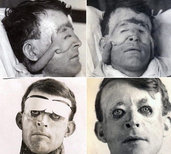 6. Произошла первая в мире пластическая операция в графстве Кент, Англия