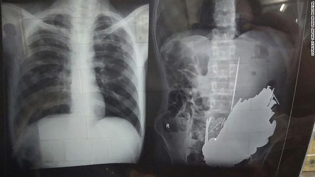'Son bir aydır ağrılardan şikayet ediyordu. Yapılan tetkiklerden sonra karın bölgesinde enfeksiyon ve düşük tansiyon olduğunu anladık. Durumu ciddiydi.'