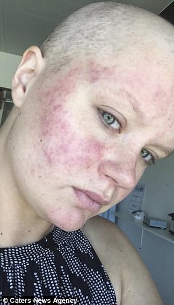 4. Даже после операции и химиотерапии, которая далась Ноулз очень нелегко, опухоль продолжала расти.