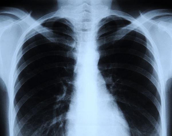 “Hamileler X-Ray cihazından geçemez, akciğer filmi çektiremez.”