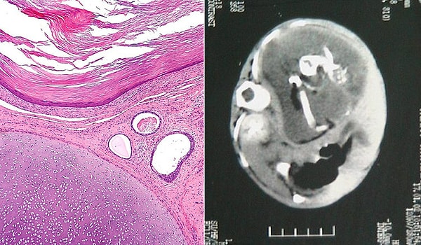 2. Опухоль может иметь волосы, зубы, кости и даже сложные органы, такие как глаза и мозговое вещество. В редких случаях она может включать в себя структуры, напоминающие человеческий плод.
