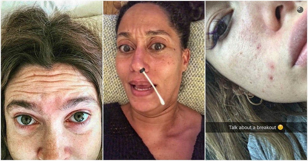 11 знаменитостей, не побоявшихся показать свои недостатки всему миру