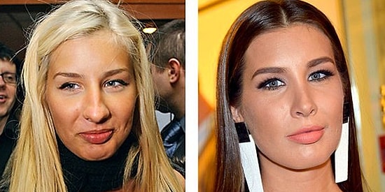 11 российских звезд, удачно изменивших форму носа