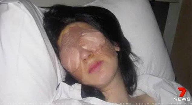 2. Enfeksiyon sonrası gözleri bir anda tamamen kapanan genç kadın