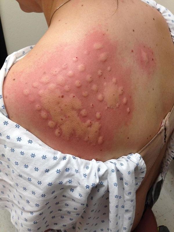10. "Kız kardeşim alerji testi yaptırdı ve denedikleri her şeye karşı alerjisi olduğu ortaya çıktı. En kötüsü ise atlara karşı olan alerjisi."