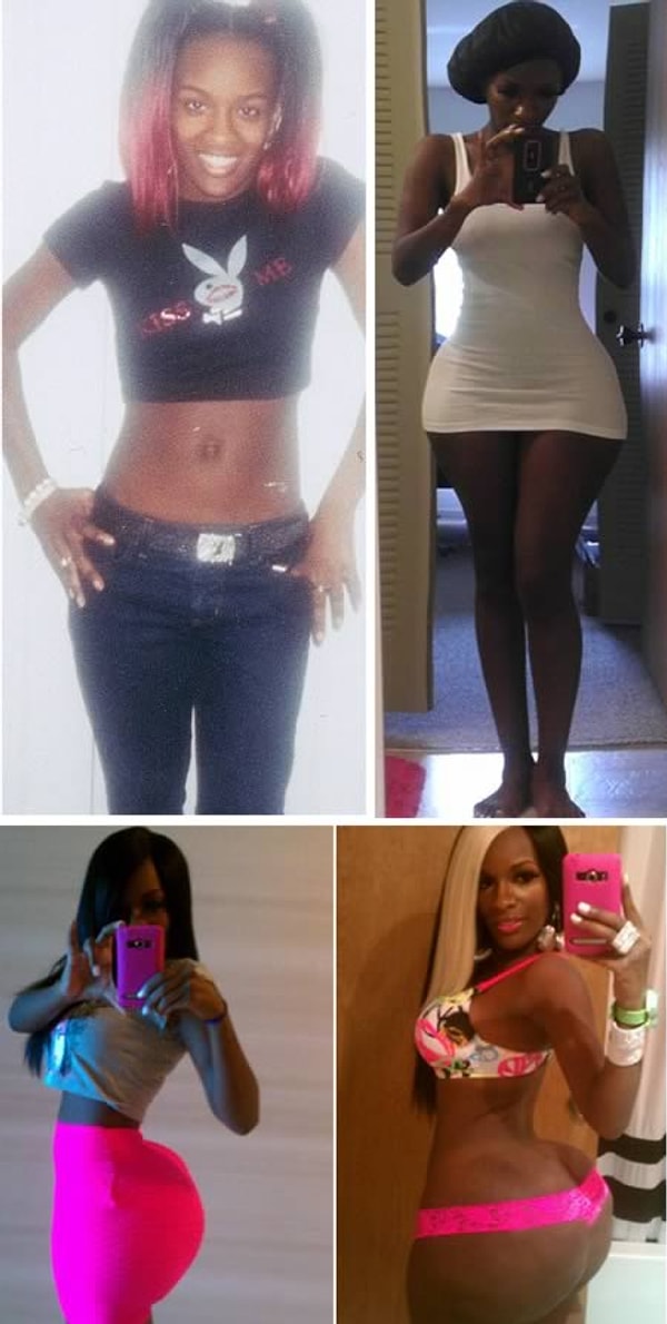 8. Женщина, потратившая 15 тыс. долларов на нелегальные инъекции в ягодицы