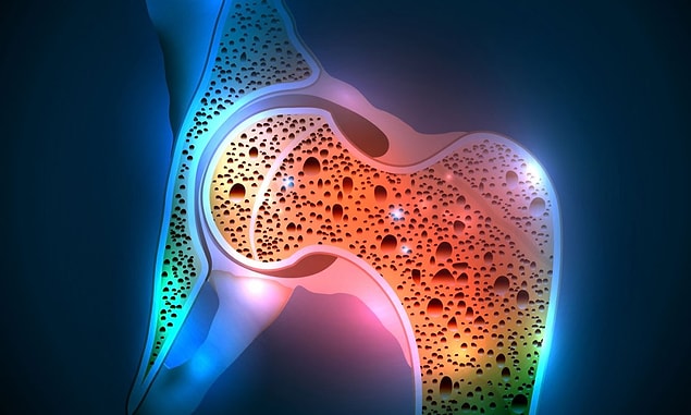 1. Osteoropoz