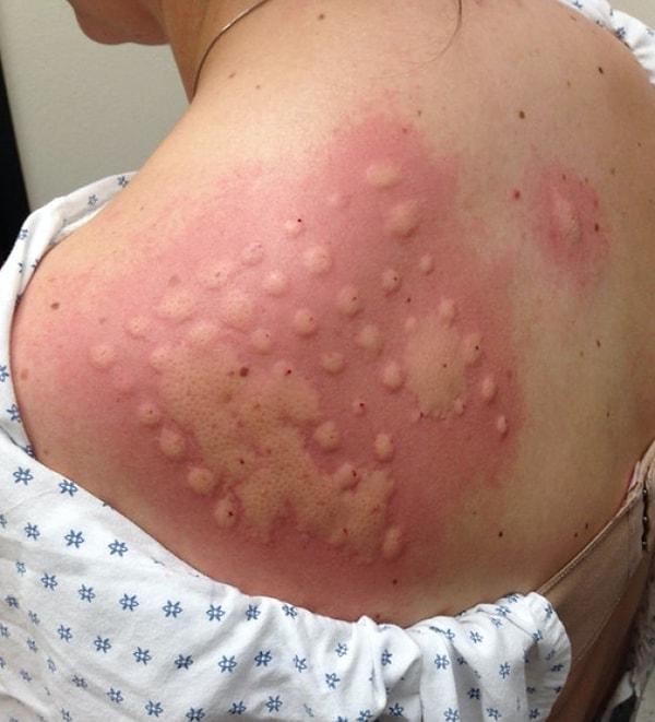 3. "Kardeşim alerji testinden sonra her şeye alerjisi olduğunu anladı."
