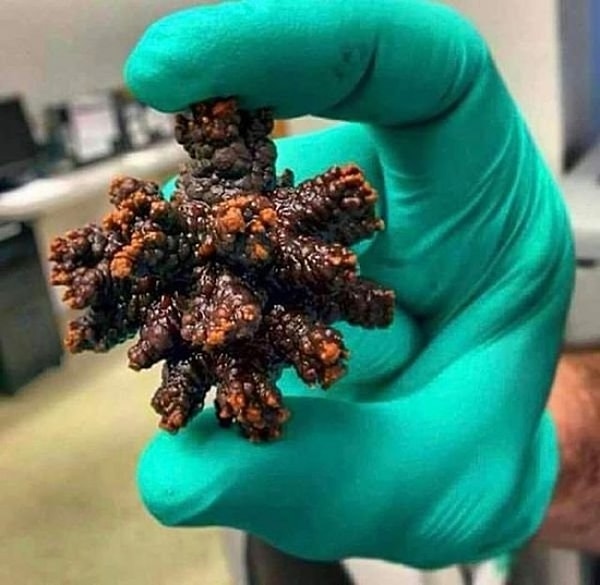 11. Камень, извлеченный из тела человека