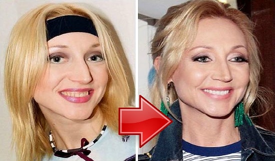 10 российских знаменитостей, которым явно повезло с пластическим хирургом