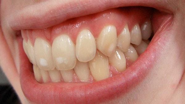 Neden bazı insanların dişlerinde beyaz lekeler vardır?