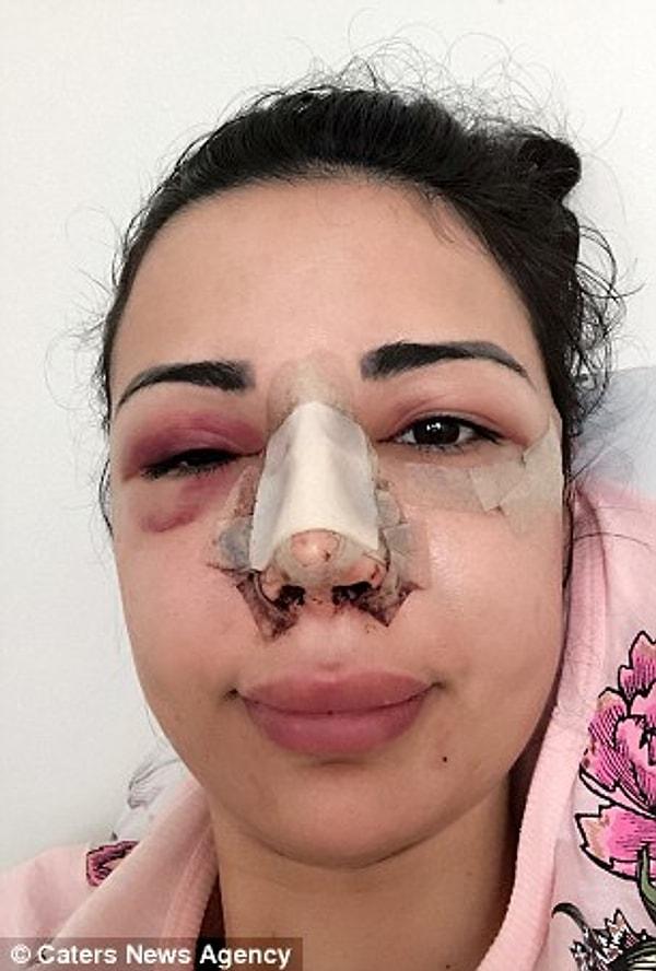 Jennifer, yaptırdığı son ameliyat için İstanbul'a seyahat etmiş ve Türk bir doktorun bıçağının altına yatmış. Bu operasyonda yanaklarındaki dolgular çıkartıldı ve ikinci bir burun estetiği yapıldı.