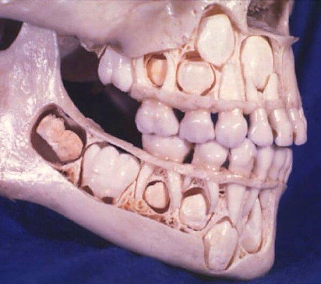 18. Bebek dişlerini kaybetmeyen bir çocuğun kafatası...