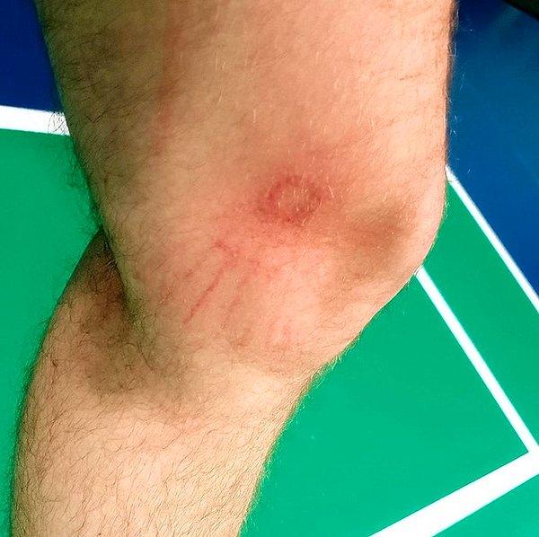 4. "Badminton oynarken bir atış sonrası bacağımda topun izi kaldı."