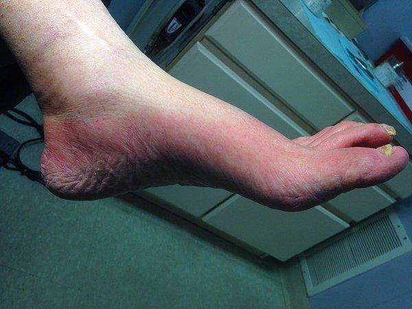 12. Ayakları sıcak suya temas ettiğinde yaşadığı bu durumu görüp doktoruna başvuran bir hasta üzerine tartışıldı.
