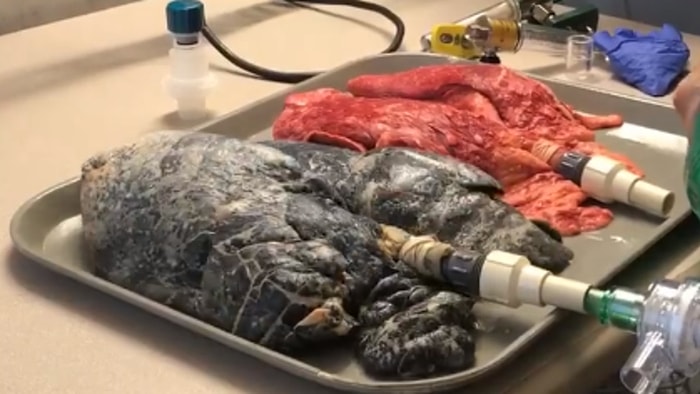 20 Yıl Boyunca Günde 1 Paket Sigara İçen Kişinin Akciğeri ile Sigara İçmeyen Akciğer Karşılaştırması