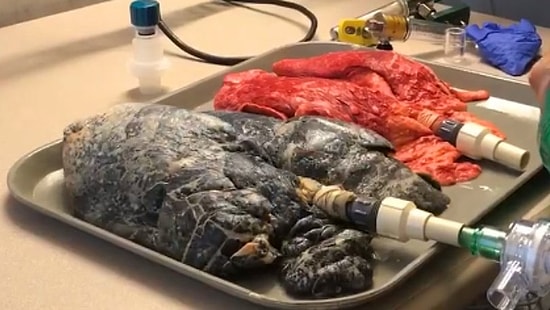 "Без комментариев": врачи сняли на видео легкие здорового человека и легкие курильщика