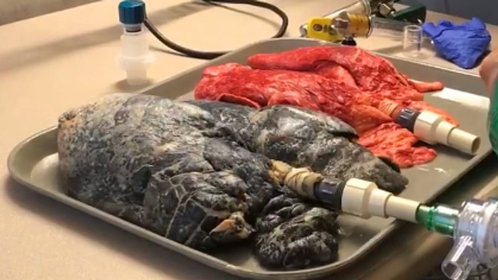 "Без комментариев": врачи сняли на видео легкие здорового человека и легкие курильщика