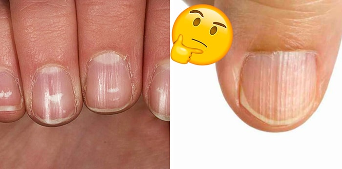 8 проблем с ногтями, которые на самом деле могут подавать важные сигналы о вашем здоровье!