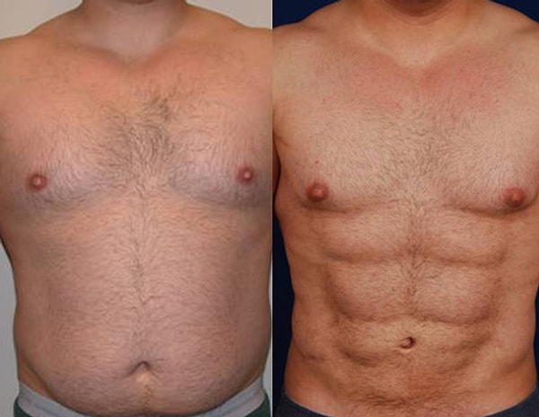 10. Эстетические операции на брюшные мышцы