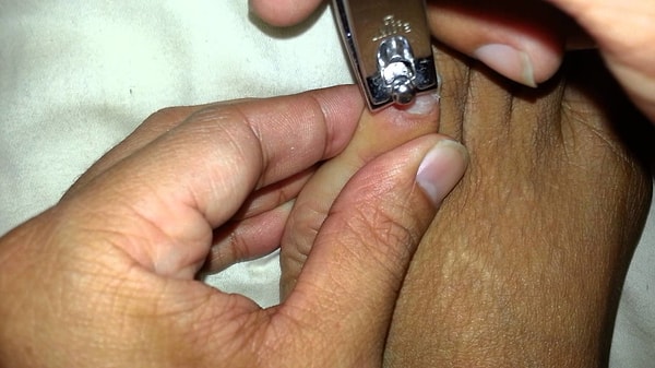 8. Помните, что маникюрист не может лечить вросший ноготь.