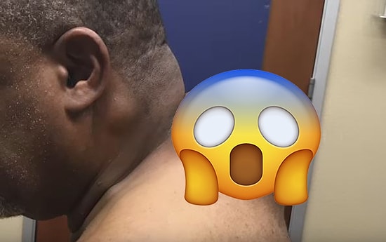 Sivilcelerin ve Aknelerin En Büyük Düşmanı Pimple Popper'dan Sevenlerine Hipnoz Etkili Video!