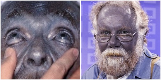 Gözlerinize İnanamayacaksınız! Mavi Tenleriyle Adeta Şirinler Köyü'nden Fırlamış Gibi Görünen Dünyanın En Garip Ailesi