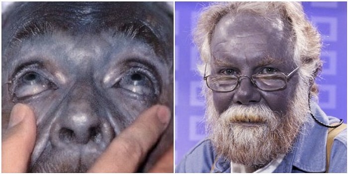 Gözlerinize İnanamayacaksınız! Mavi Tenleriyle Adeta Şirinler Köyü'nden Fırlamış Gibi Görünen Dünyanın En Garip Ailesi