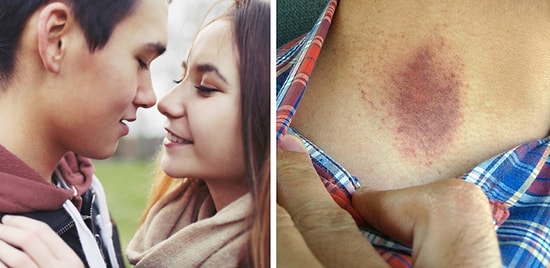 17-летний парень умер от инсульта после того, как девушка поставила ему засосы