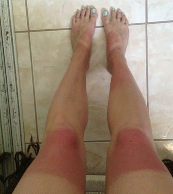 8. Мечту о ровном загаре разрушили джинсы с дырками на коленках!