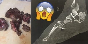 Hannibal, Sen misin? Motosiklet Kazasında Paramparça Olan Bacağını Pişirip Arkadaşlarıyla Ziyafet Çeken Adam!