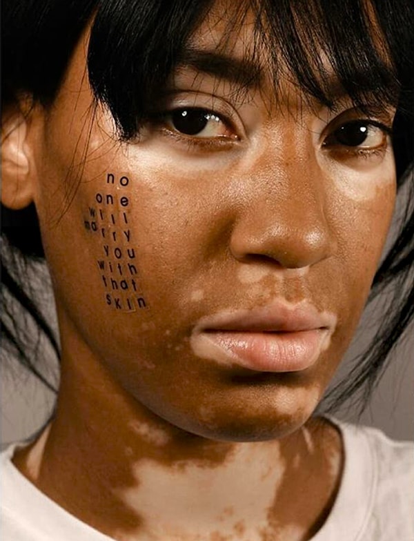 7. "С такой кожей никто на тебе не женится", - регулярно говорят этой девушке.