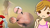 Sık Sık Nereye Kadar! Baş Belası Siyah Noktalardan Kurtulmanızı Sağlayacak 11 Doğal Maske Tarifi