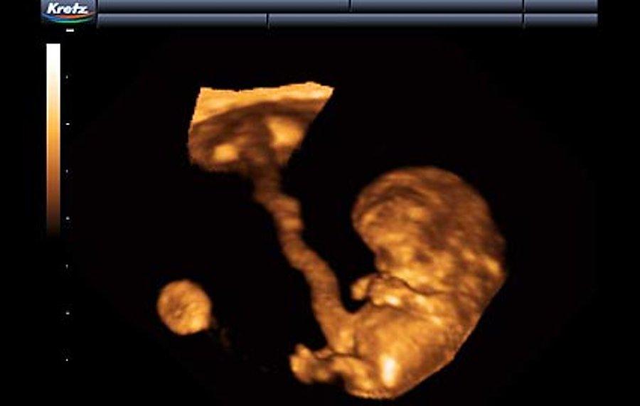 hamilelikte 11 hafta artik gobeginiz belirginlesiyor onedio com