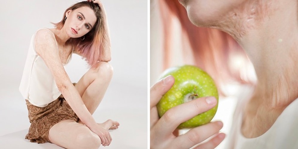 Другая красота: Как ожоги и мучения принесли славу девушке-подростку из России