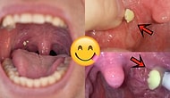 Sivilce Sıkma Videolarından Sonra Aynı Zevki Veren Yeni Trend: Bademcik Taşı Çıkarma