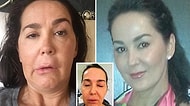 Düzenli Botoks Uygulamasının 10. Yılında Felç Olup Yatağa Mahkum Kalan Talihsiz Makyaj Sanatçısı