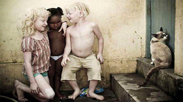 Dünyanın her yerinde albino olan bireyler modellikten müzisyenliğe birçok mesleği icra ederken, Afrika halkı albino bireylerin lanetli olduğuna ve uzuvlarını kesmenin uğur getirdiğine inanıyor.