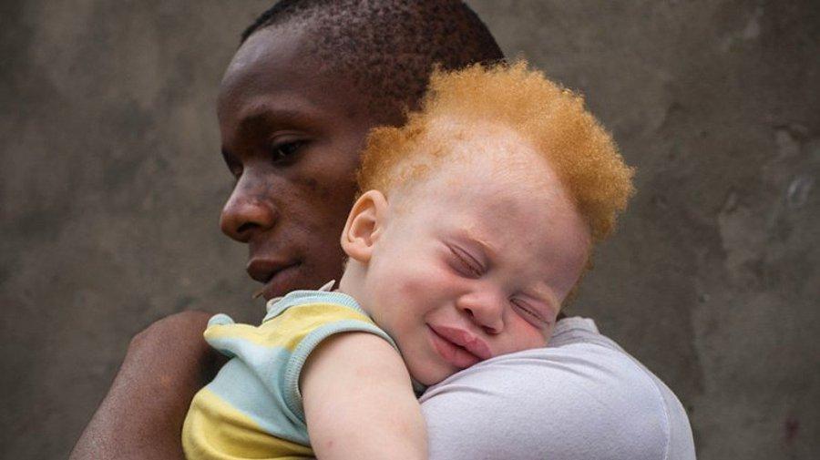 Afrika Da Lanetli Olduklarina Inanilan Ve Uzuvlari Kesilerek Yuksek Meblaglara Satilan Albinizmli Cocuklar Onedio Com