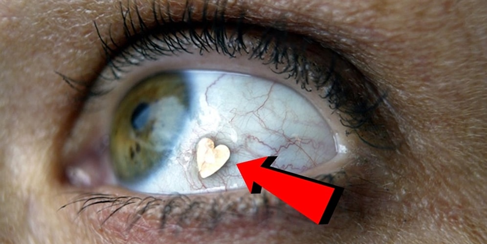 Бижутерия для глаз: мода на украшения из платины, вставленные в глазное яблоко