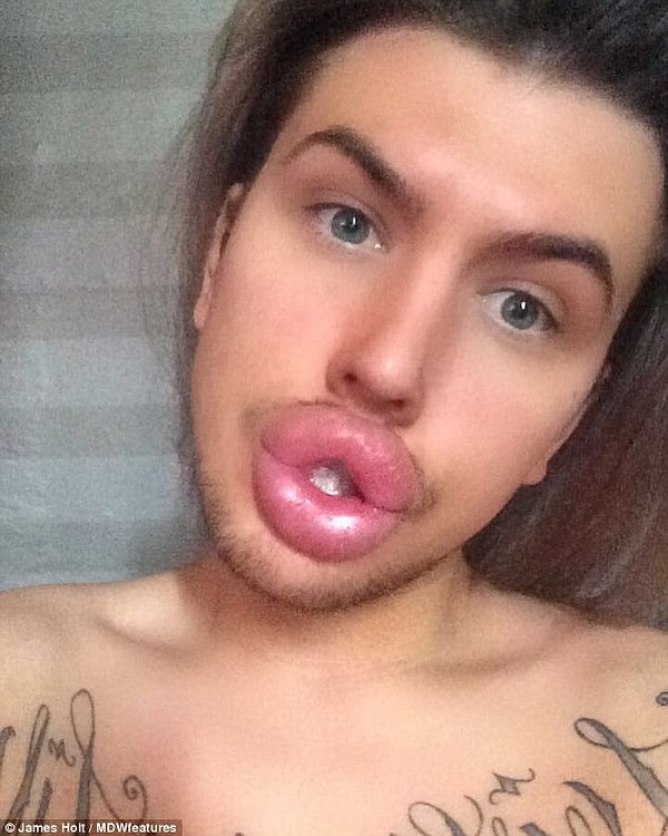 "Мои друзья и семья не довольны результатами. Они говорят, что я перегнул палку, и очень боятся, что мои губы просто 'отвалятся' или лопнут"