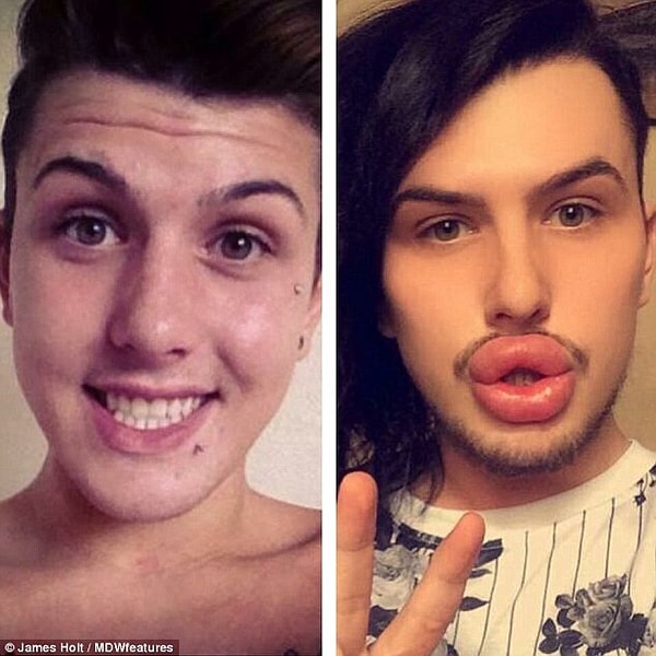 Два раза в год Джеймс отбеливает зубы, а сейчас, в жаркий период, он решил вколоть ботокс для подмышек, чтобы не потеть.