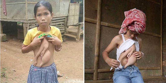 14 Yaşındaki Taylandlı Veronica, Göğsünde Büyüyen Parazit İkizinin Alınması İçin Ameliyata Hazırlanıyor!